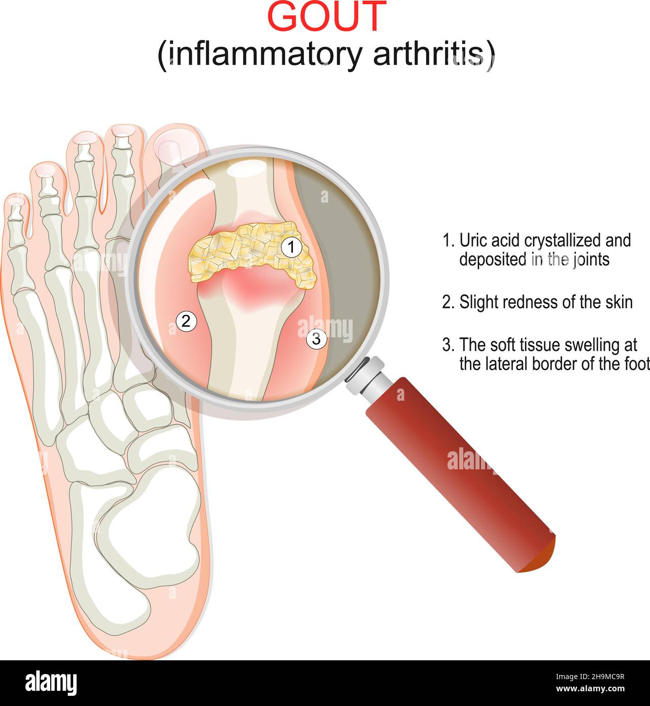 Gout. Close-up of joint with inflammatory arthritis. Humans foot with crystallization of uric acid and magnifying glass. Vector illustration. poster e Stock Vector