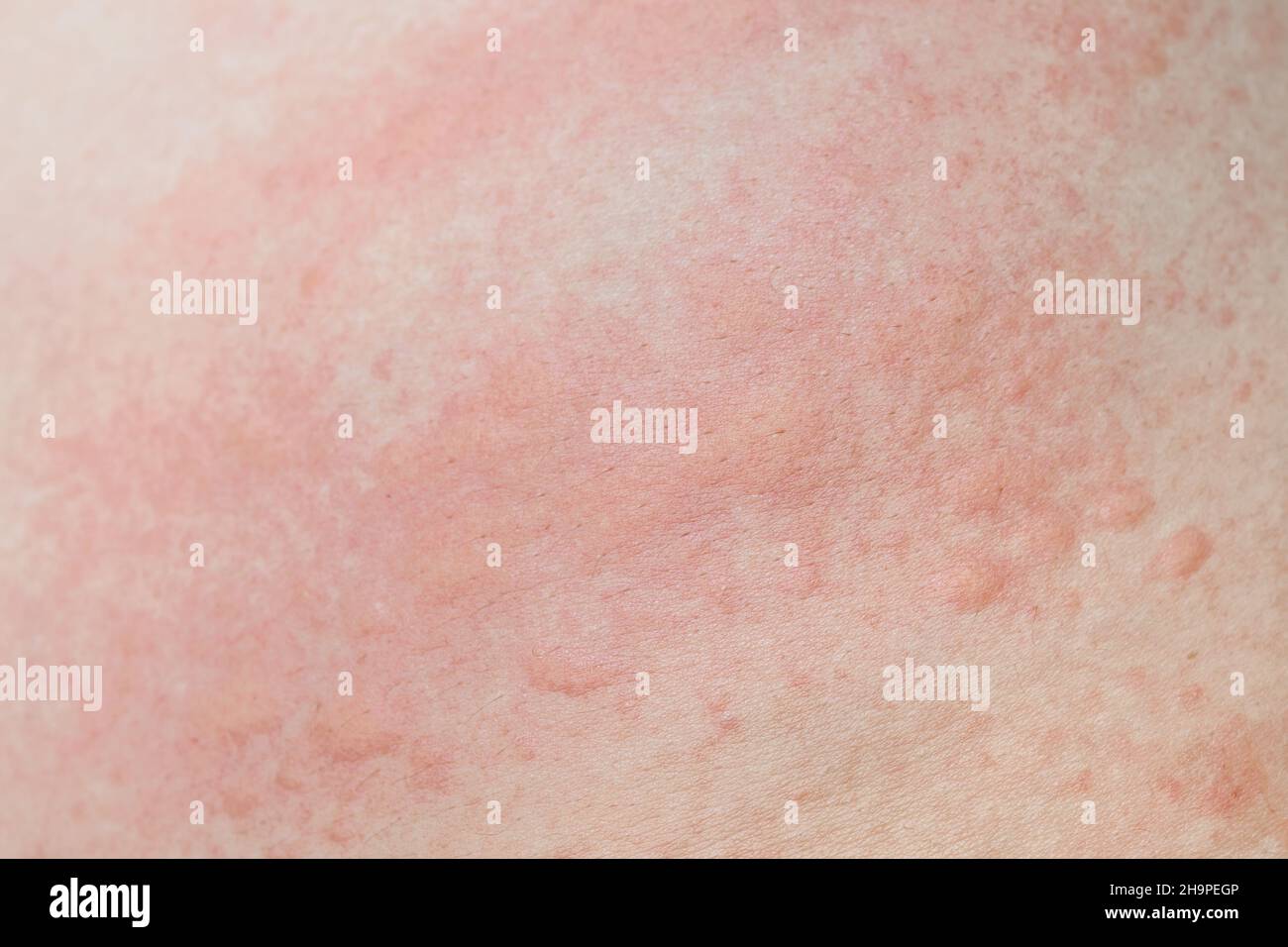 tjener stimulere På hovedet af Prickly heat rash hi-res stock photography and images - Alamy