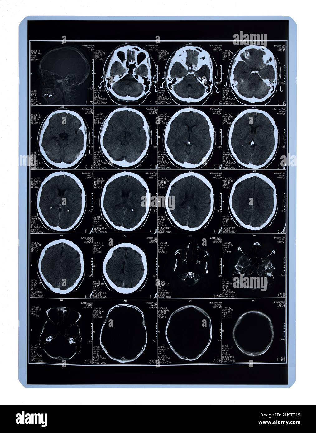 MR-scan of a brain. Stock Photo