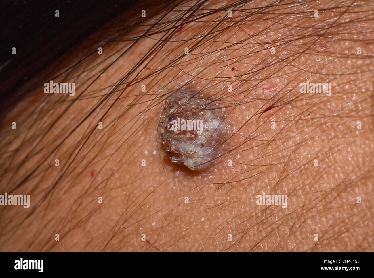 Common wart at the forehead of Asian, Myanmar young man. It is a small, hard, benign growth on the skin, caused by human papilloma virus. Isolated on Stock Photo
