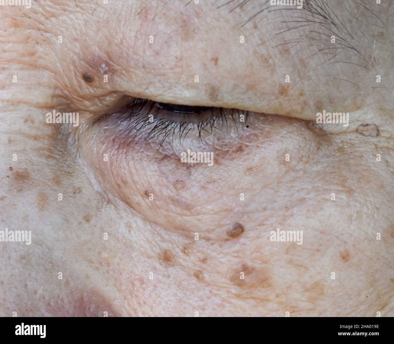 Aging skin folds or skin creases or wrinkles and aging spots at face especially around eye of Southeast Asian, Chinese elderly woman. Closeup view. Stock Photo