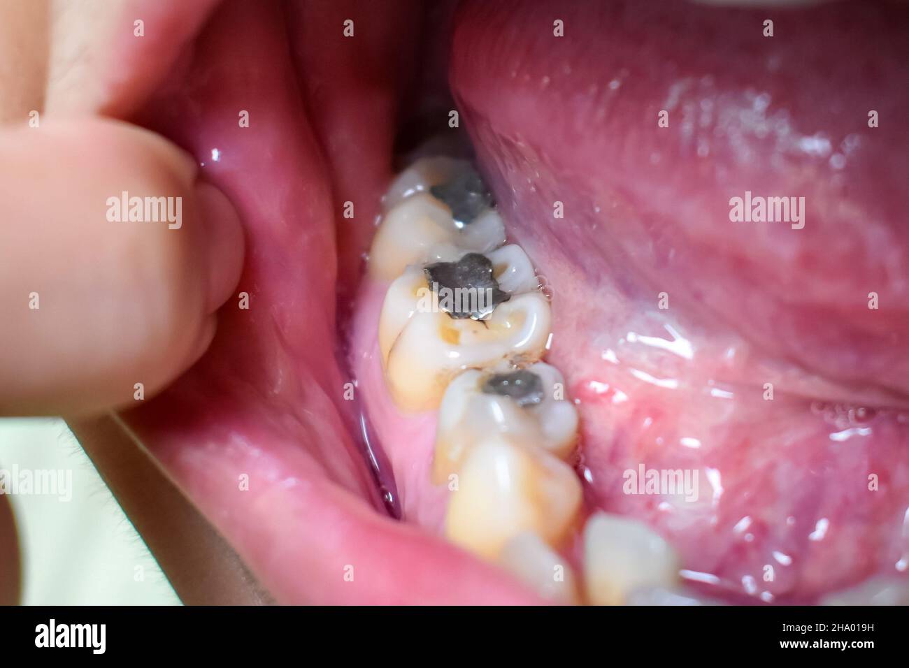 Silver amalgam fillings at right lower first molar and left lower second premolar teeth in Asian, young man. Dental caries are also present showing po Stock Photo