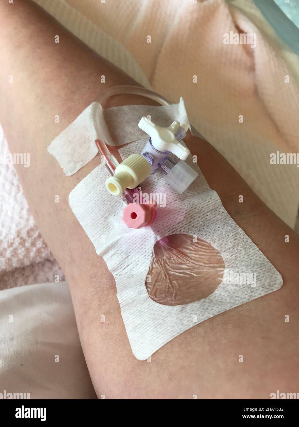 An IV or drip intravenous in the arm of a patient lying on a hospitalbed Stock Photo