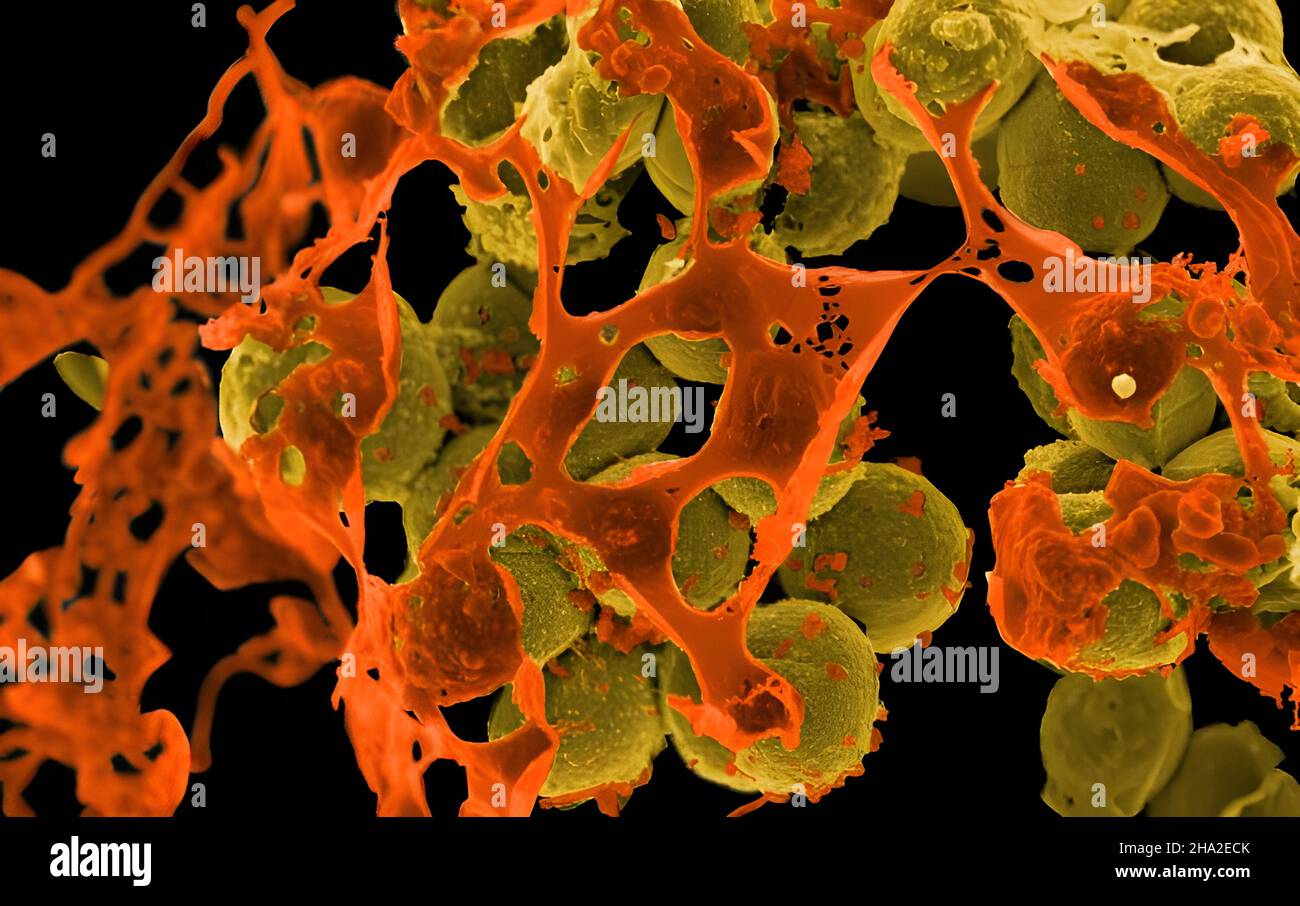 Scanning electron micrograph of methicillinresistant Staphylococcus aureus (MRSA, yellow
