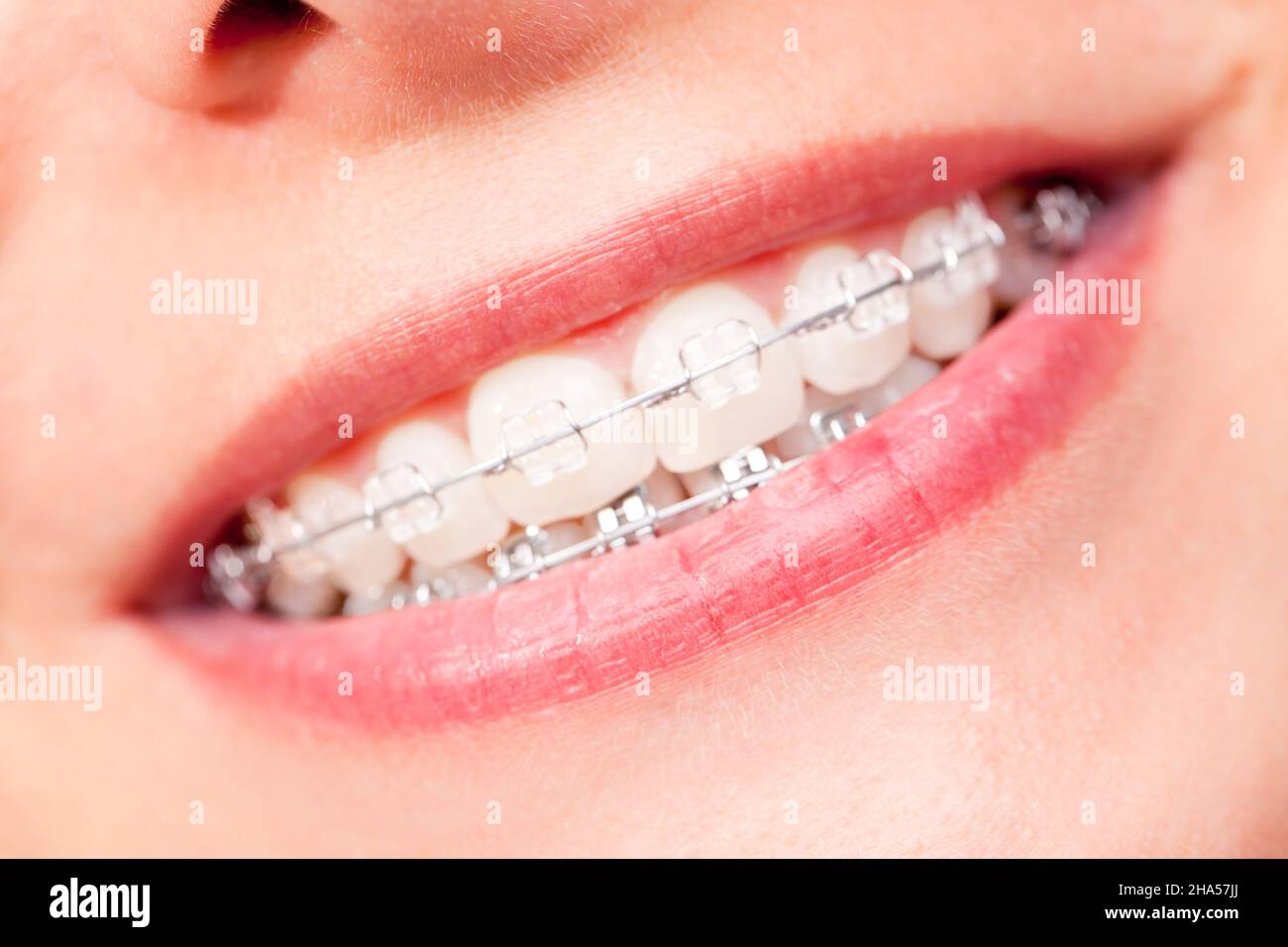 braces, mouth, woman, teeth, tooth, white, clean, health, hygiene
