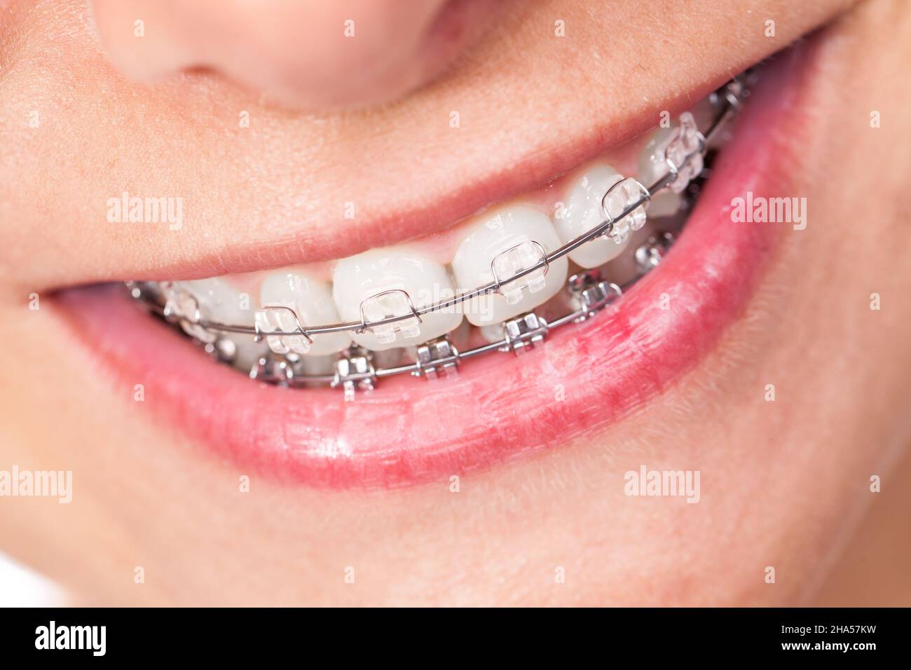 braces, mouth, woman, teeth, tooth, white, clean, health, hygiene
