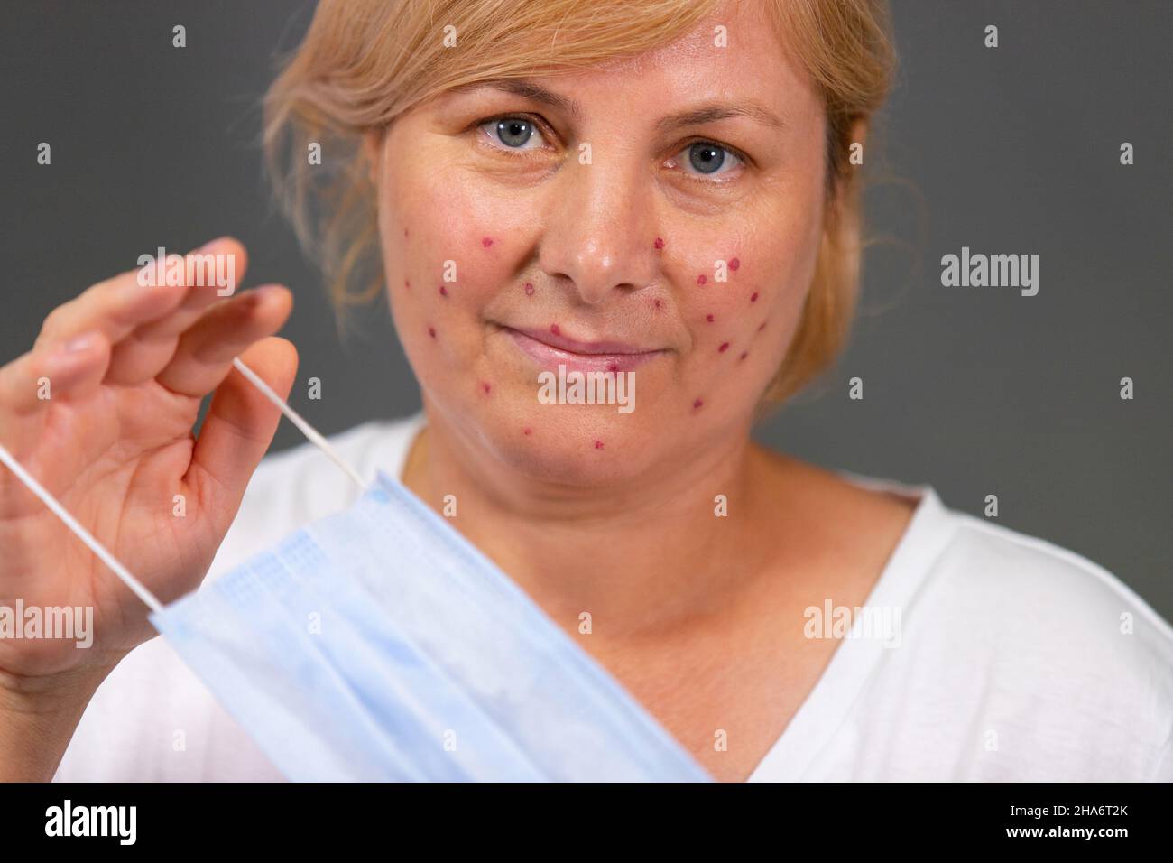 close-up-photo-of-a-pretty-blonde-woman-with-irritating-red-spots-on