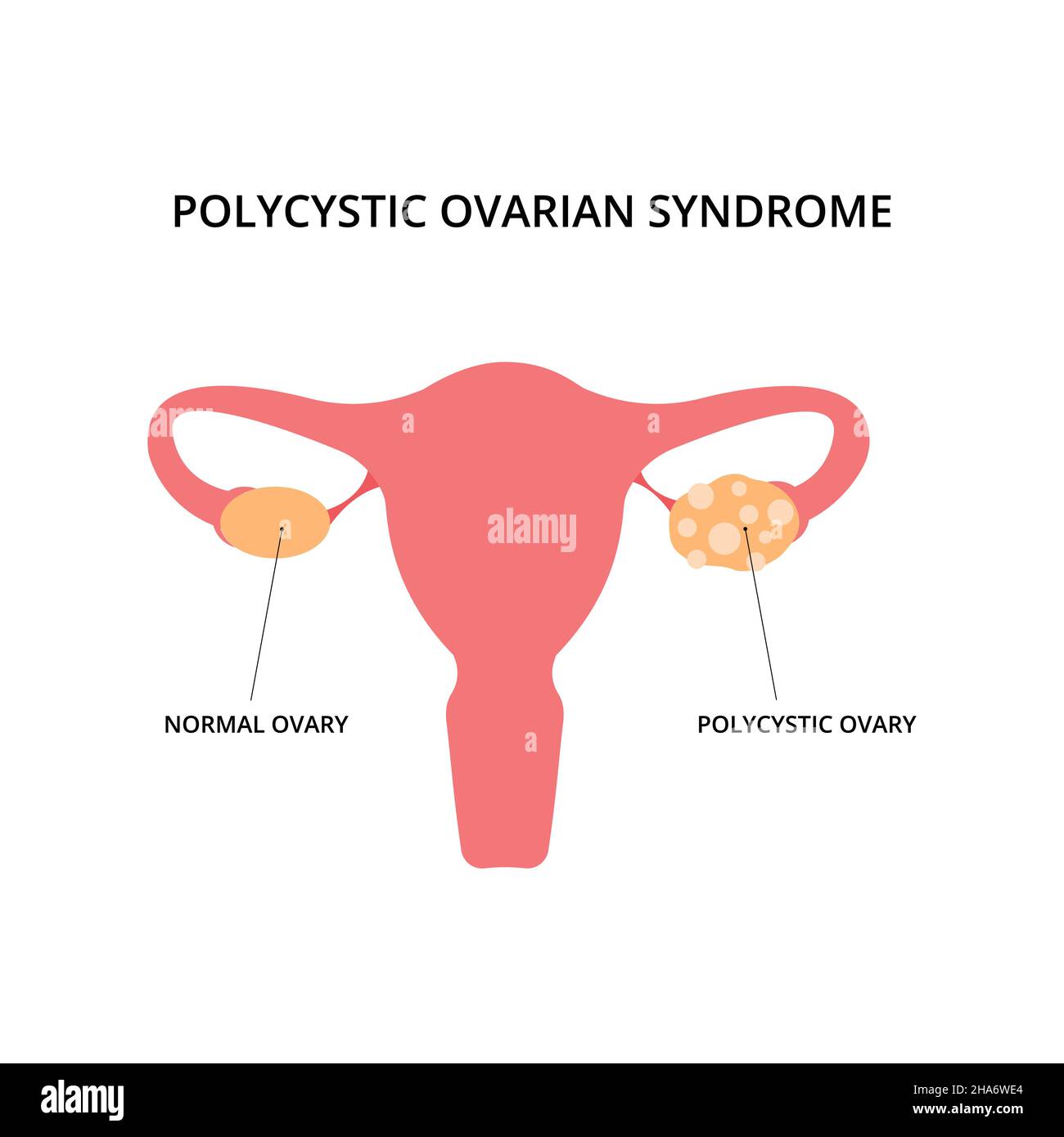 Polycystic ovarian syndrome. Uterus, infertility, gynecology. For topics like pcos, disease, pelvic floor Stock Vector