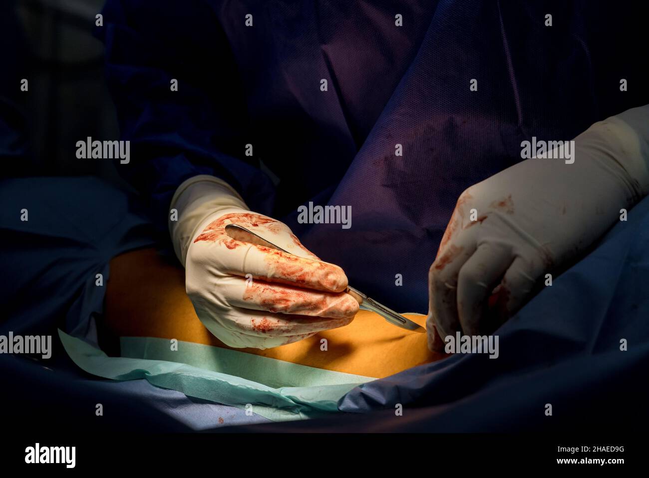 Doctor surgeon perform cutting foot during surgery for internal intervention Stock Photo