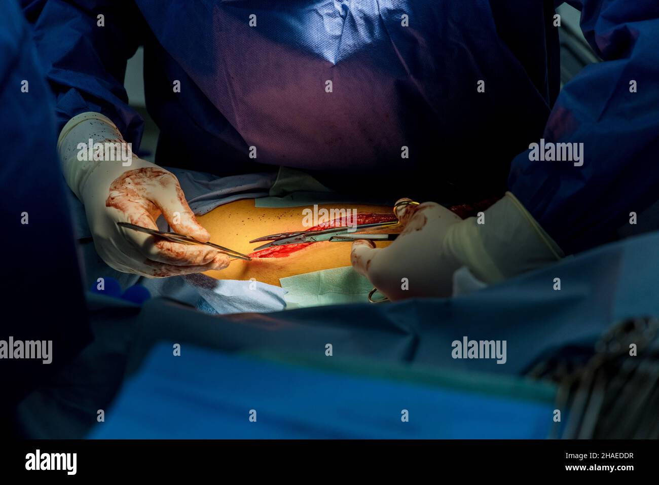 Open wounds the legs using tool using during surgery Stock Photo