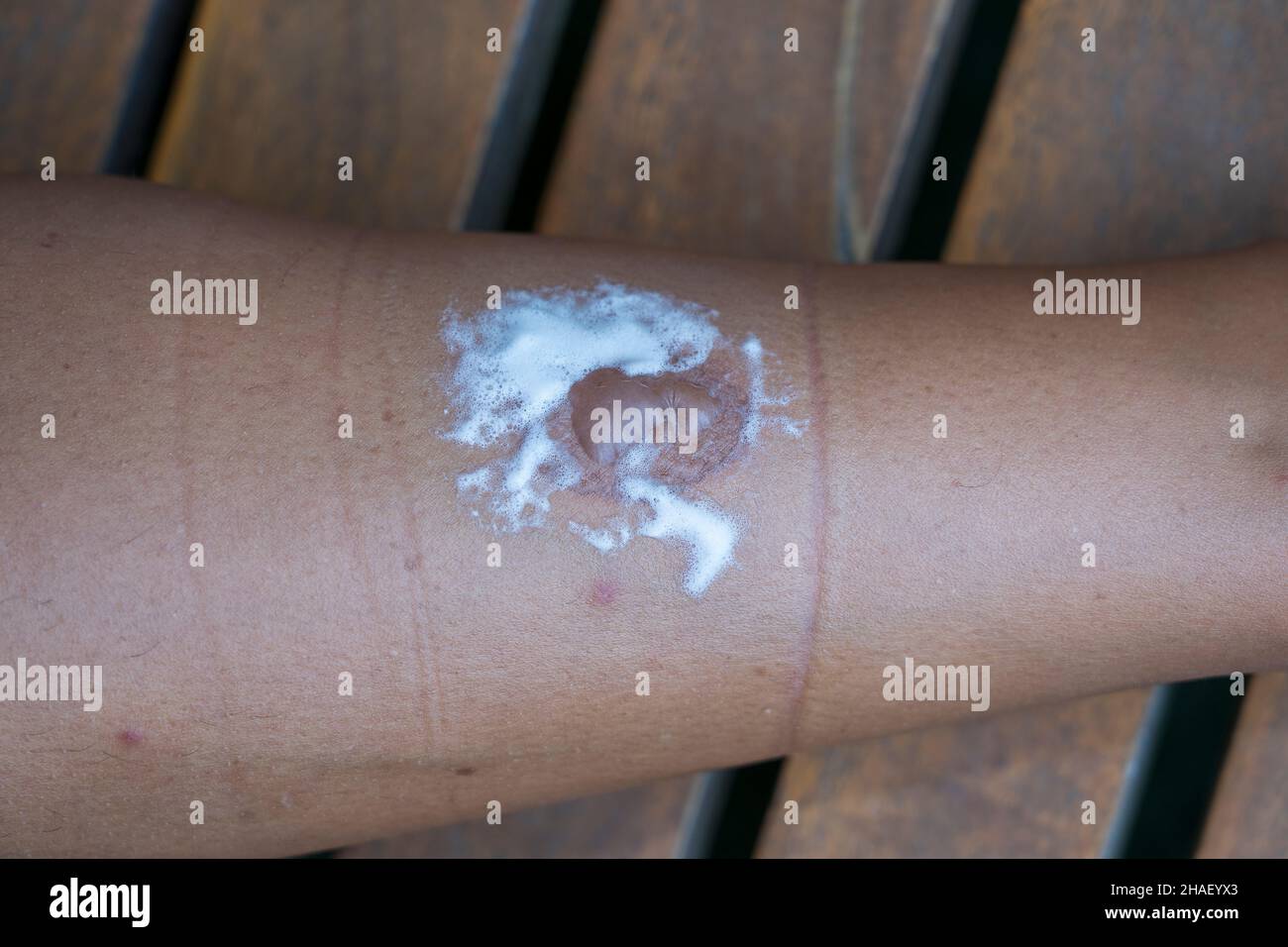 Skin burn on the leg of a young woman, close up. Injury was caused while touching the hot