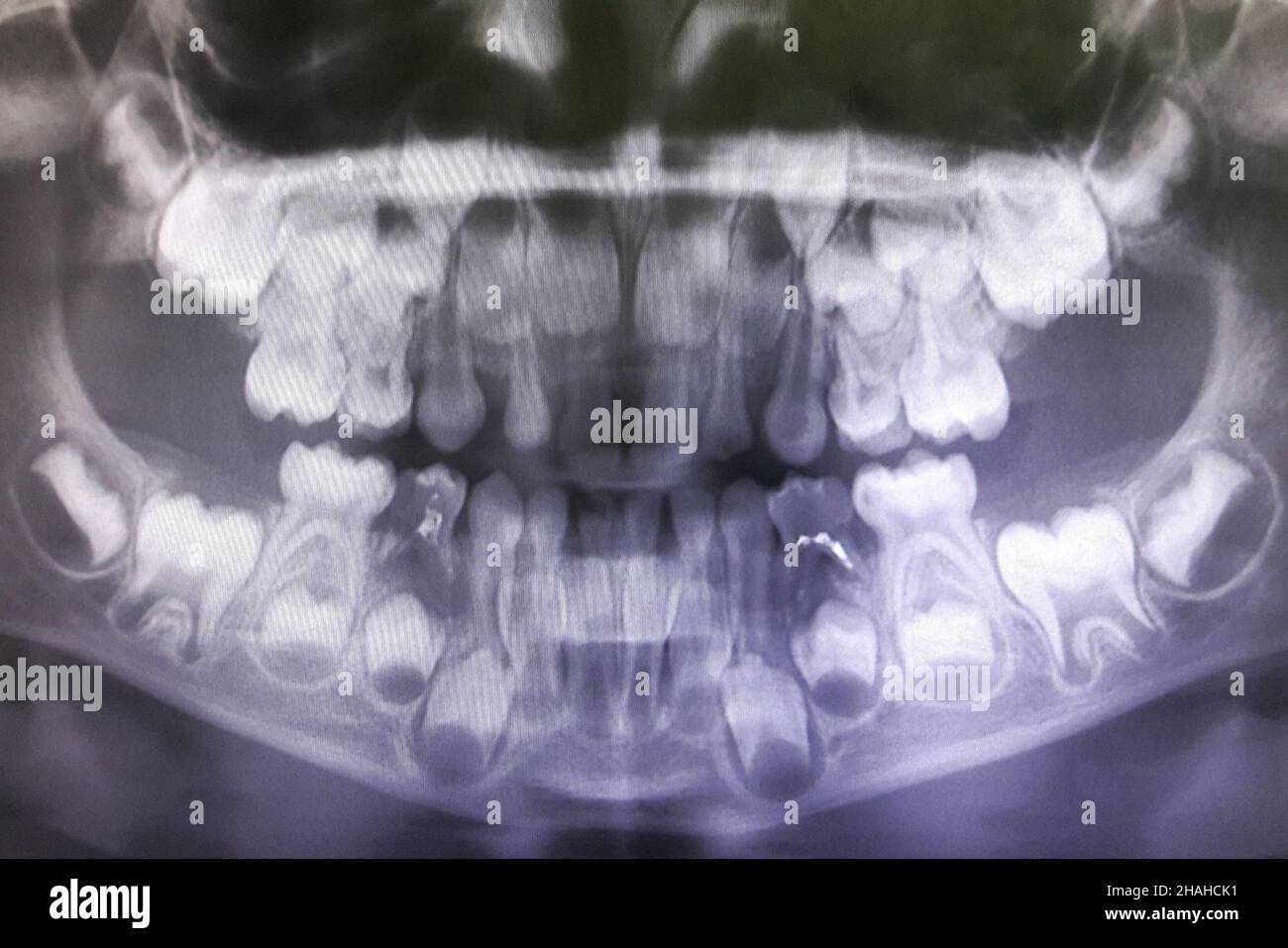 Xray of the child's upper and lower jaw with clearly visible growing