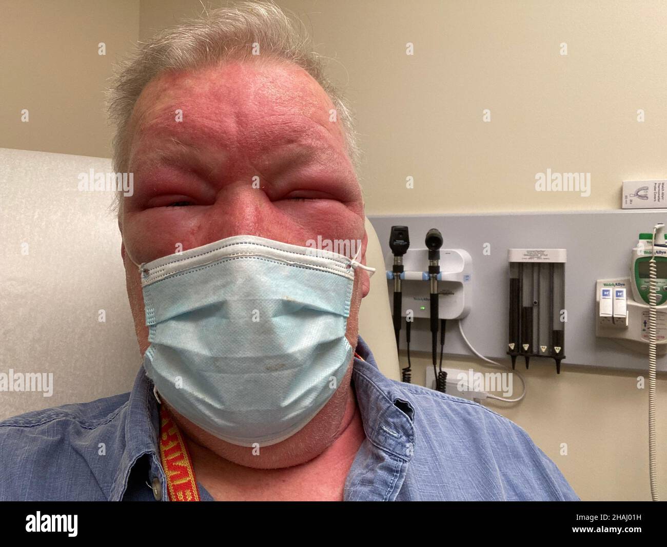 Man's face puffed up after severe poison ivy attack Stock Photo
