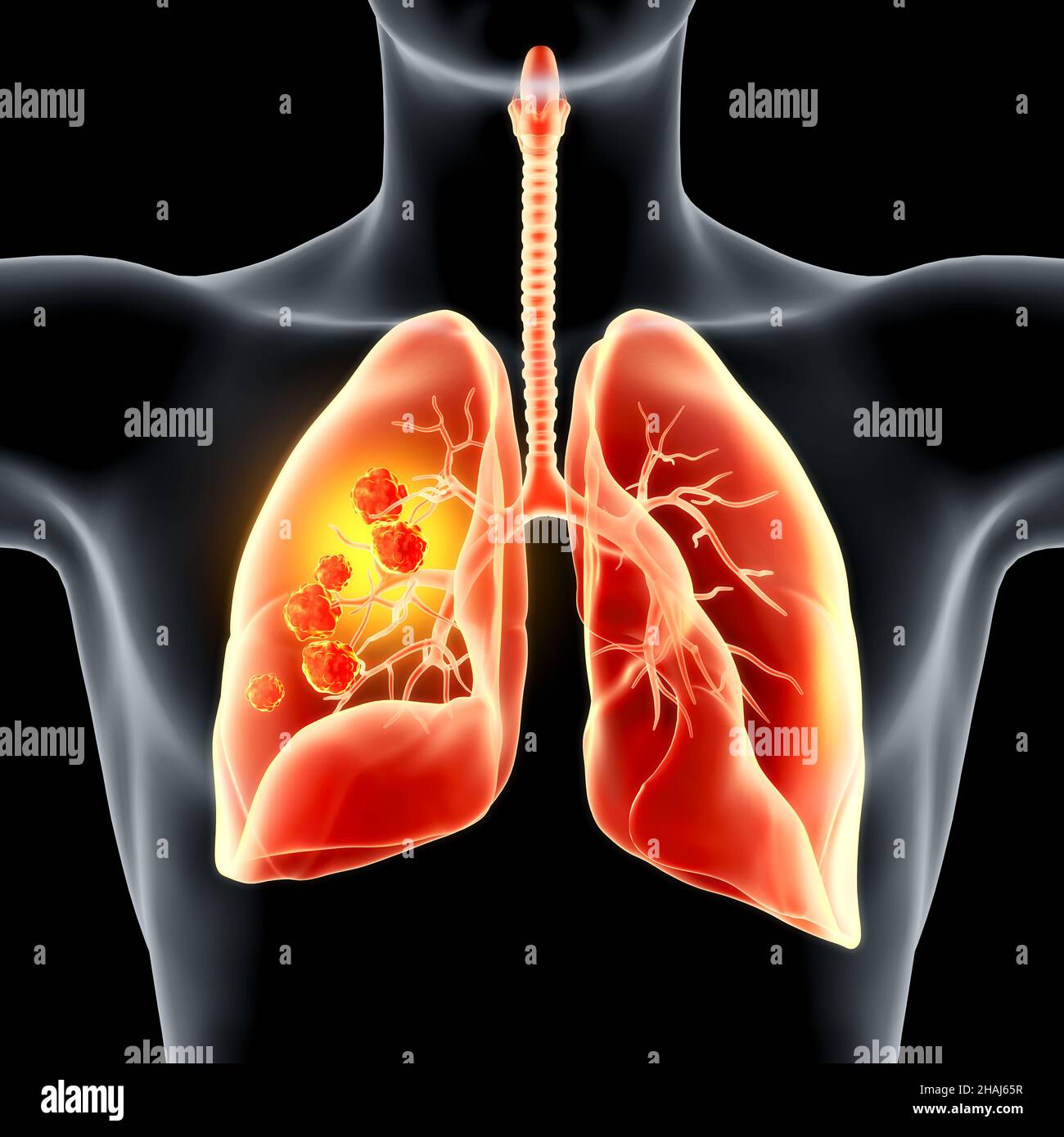 Highlighted carcinoma in right lung, 3D illustration Stock Photo