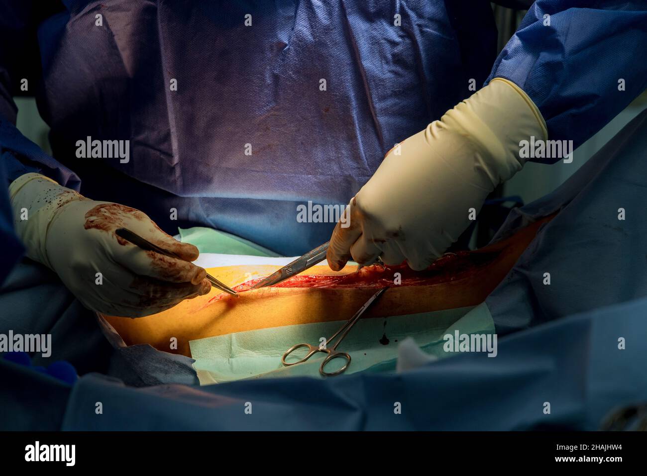 Operating during surgery with cutting legs for internal intervention Stock Photo