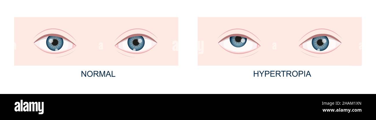 Hypertropia. Vertical strabismus before and after surgery. Human eyes healthy and with upward gaze position. Double vision. Vector cartoon illustration. Stock Vector