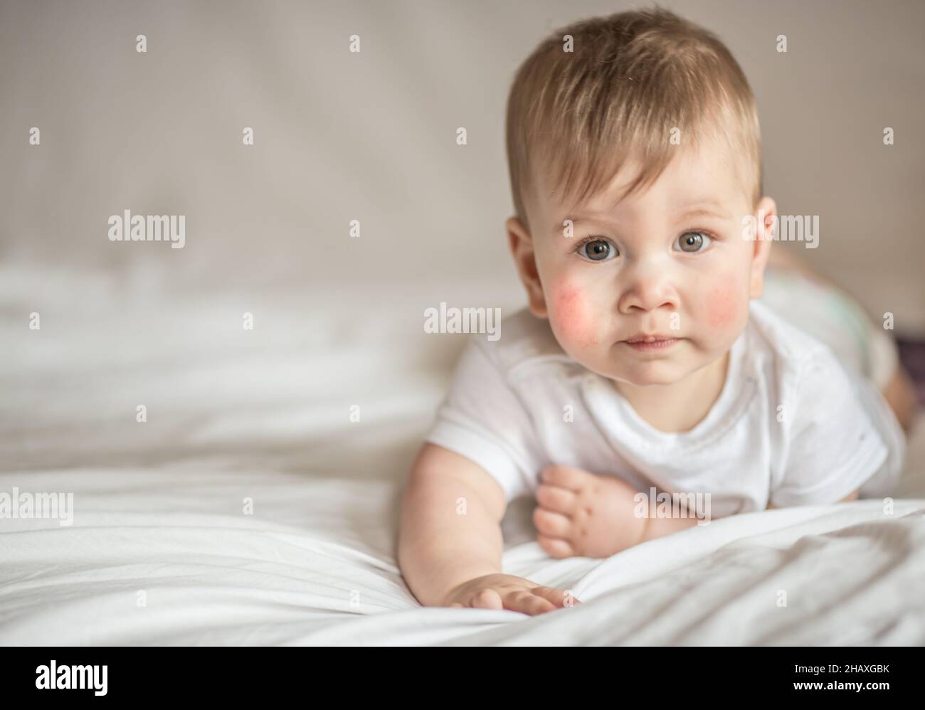 Atopic dermatitis eczema in baby.Condition that causes the skin to