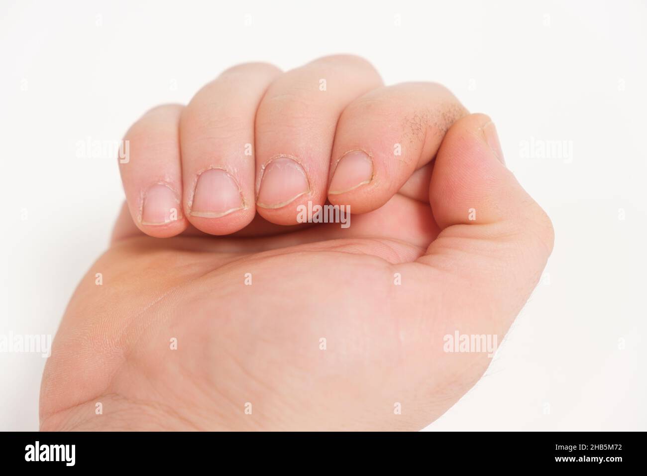 Unkempt male nails with a regrown cuticle on a white background Stock Photo