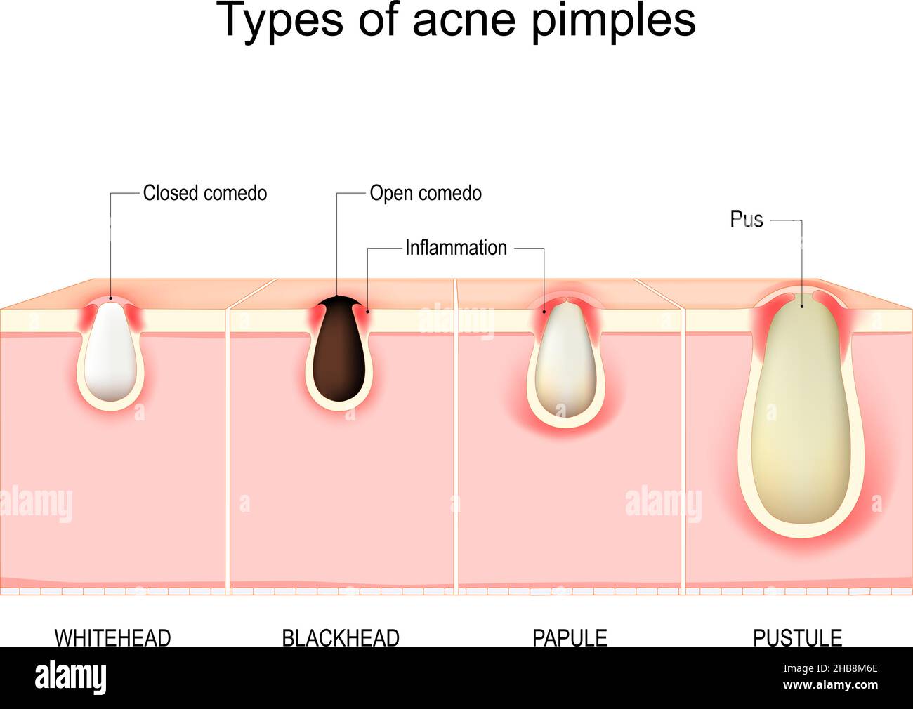 Pimple Under Skin Diagram