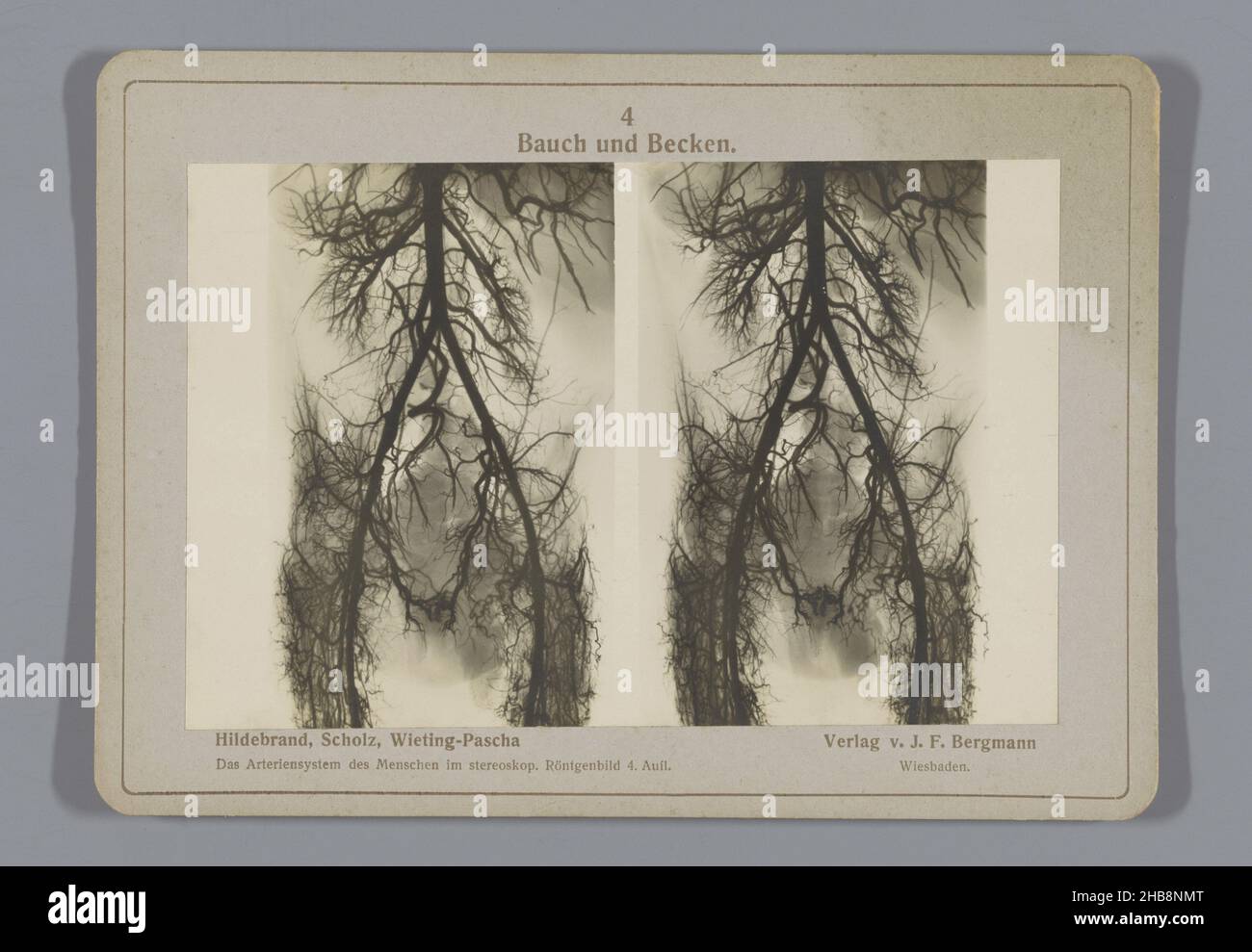 X-ray image of blood vessels in the abdomen and loins, Bauch und Becken ...