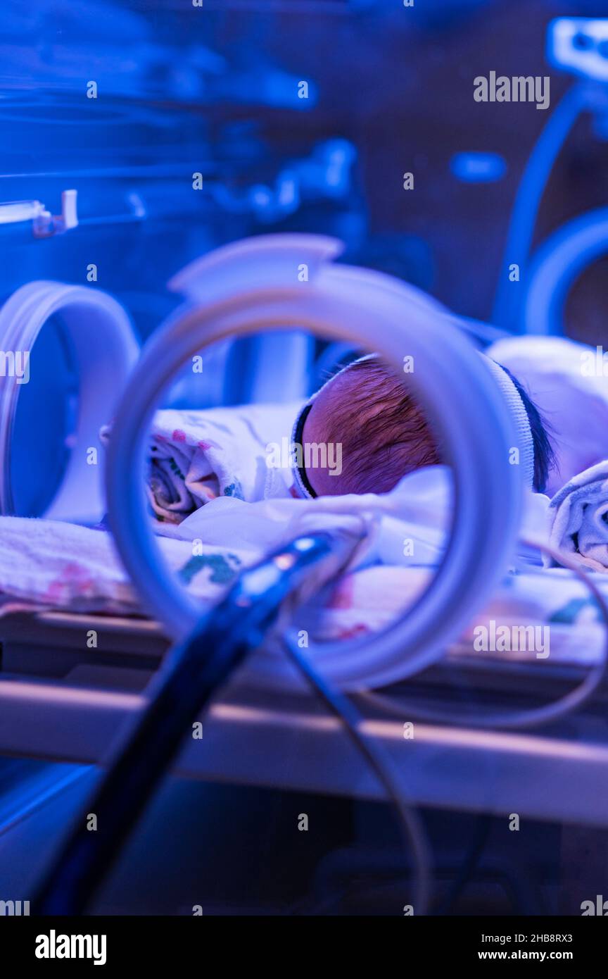 Bili light therapy hires stock photography and images Alamy