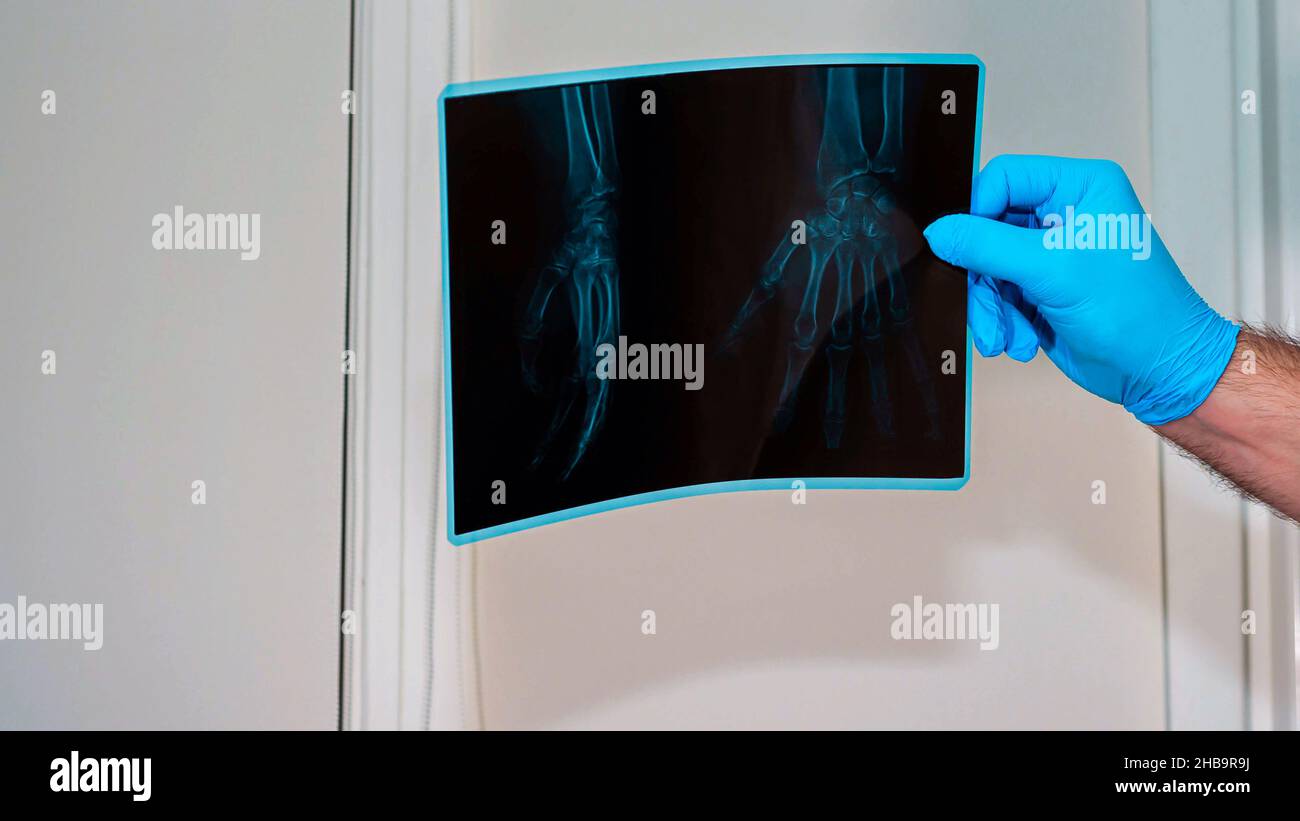 X-ray injury of the wrist. A male doctor carefully examines a hand injury, a medical professional looks at an X-ray of a bone injury. Stock Photo