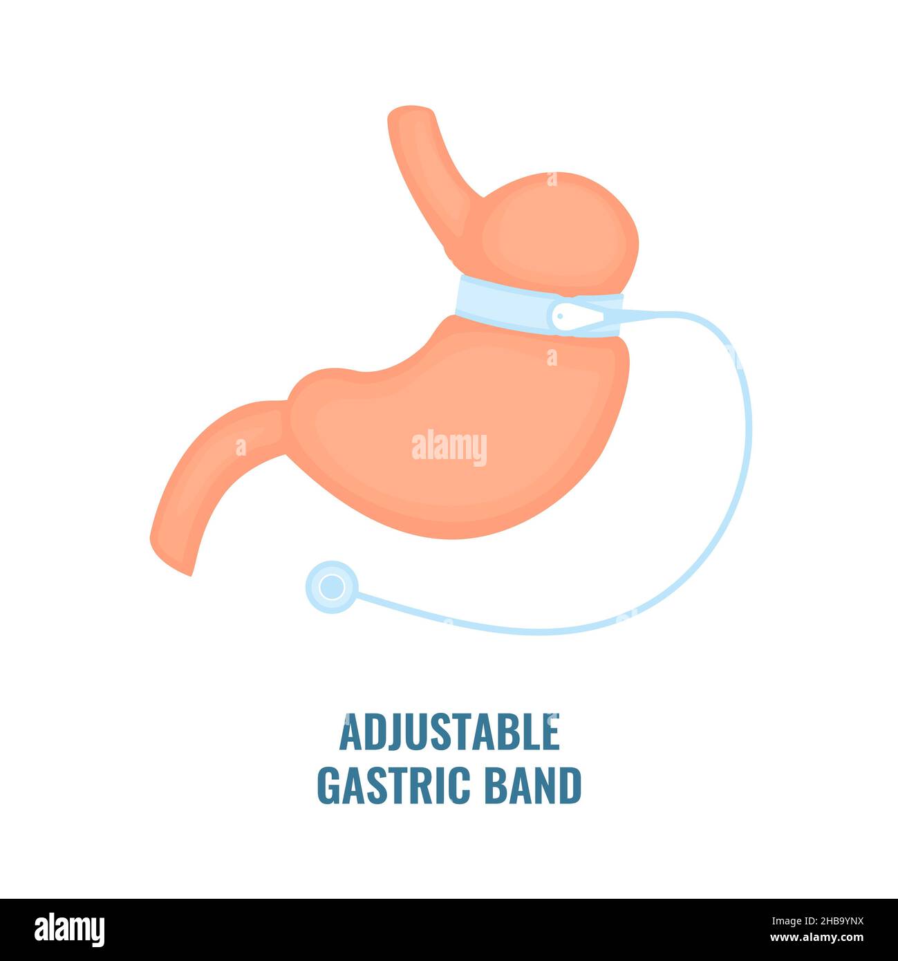 Adjustable gastric band bariatric surgery, illustration. Stock Photo