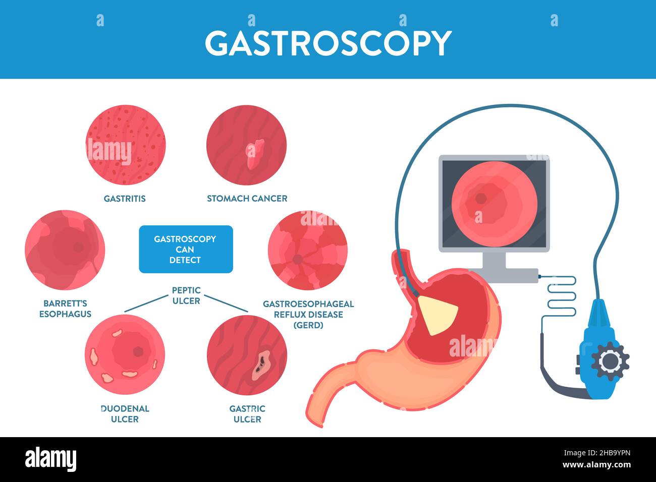 Gastroscopy, conceptual illustration. Gastroscopy is a procedure used to look at the oesophagus, stomach and the duodenum. It can be used to detect diseases, for example from left to right: stomach cancer, gastroesophageal reflux disease (GERD), gastric ulcer, duodenal ulcer, barrett's esophagus and gastritis. Stock Photo