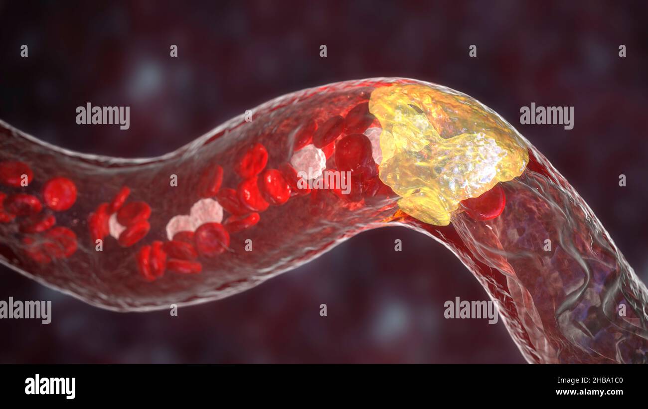 Atherosclerosis. Illustration showing fatty plaque (atheroma, yellow