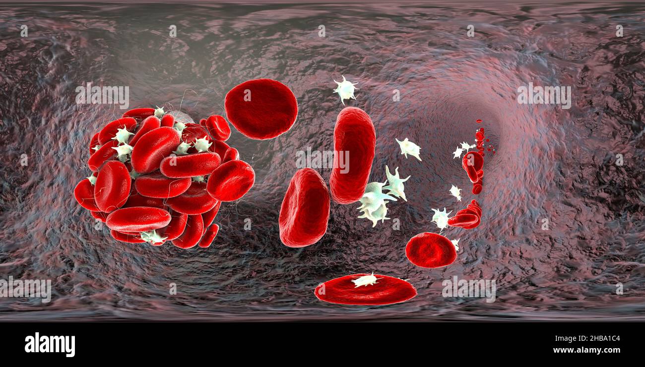 Blood clot made of red blood cells, platelets and fibrin protein