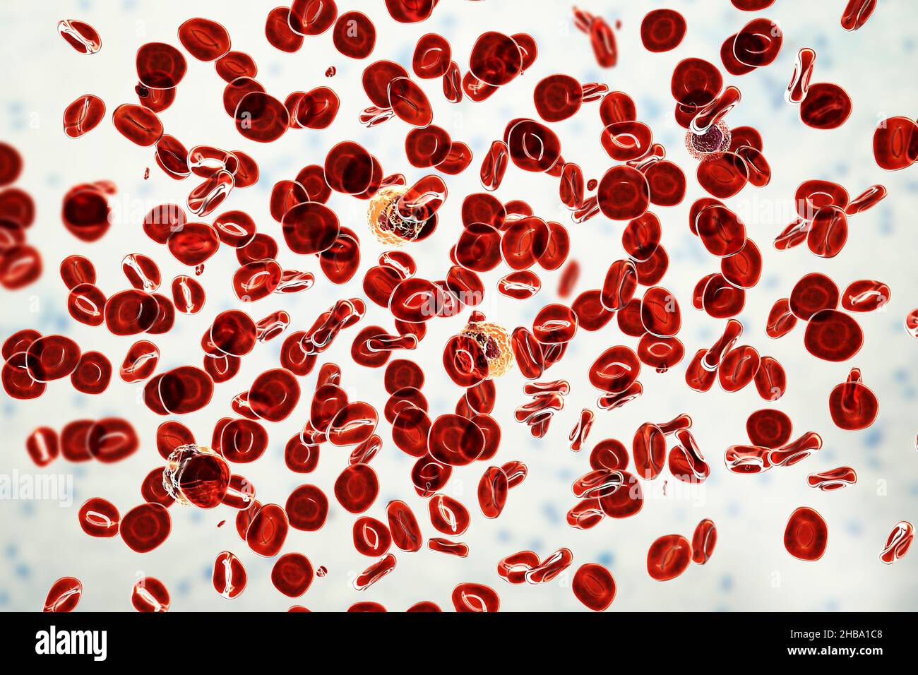 Polycythemia vera, illustration. Polycythemia vera is a rare slow