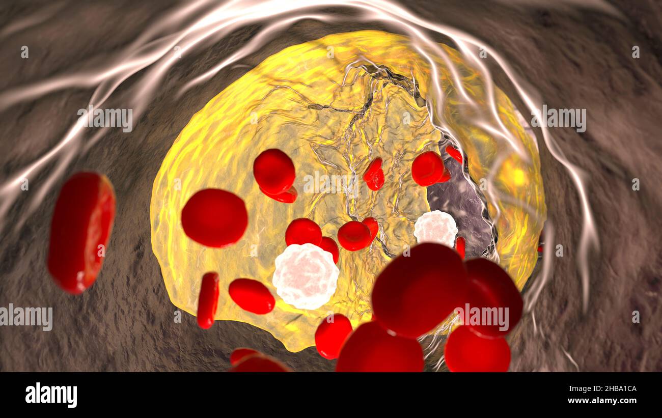 Atherosclerosis. Illustration showing fatty plaque (atheroma, yellow ...