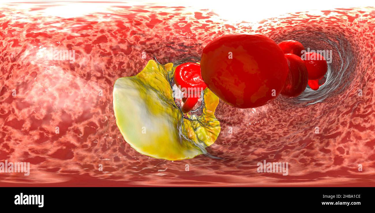 Atherosclerosis, 360 degree panorama view inside a blood vessel