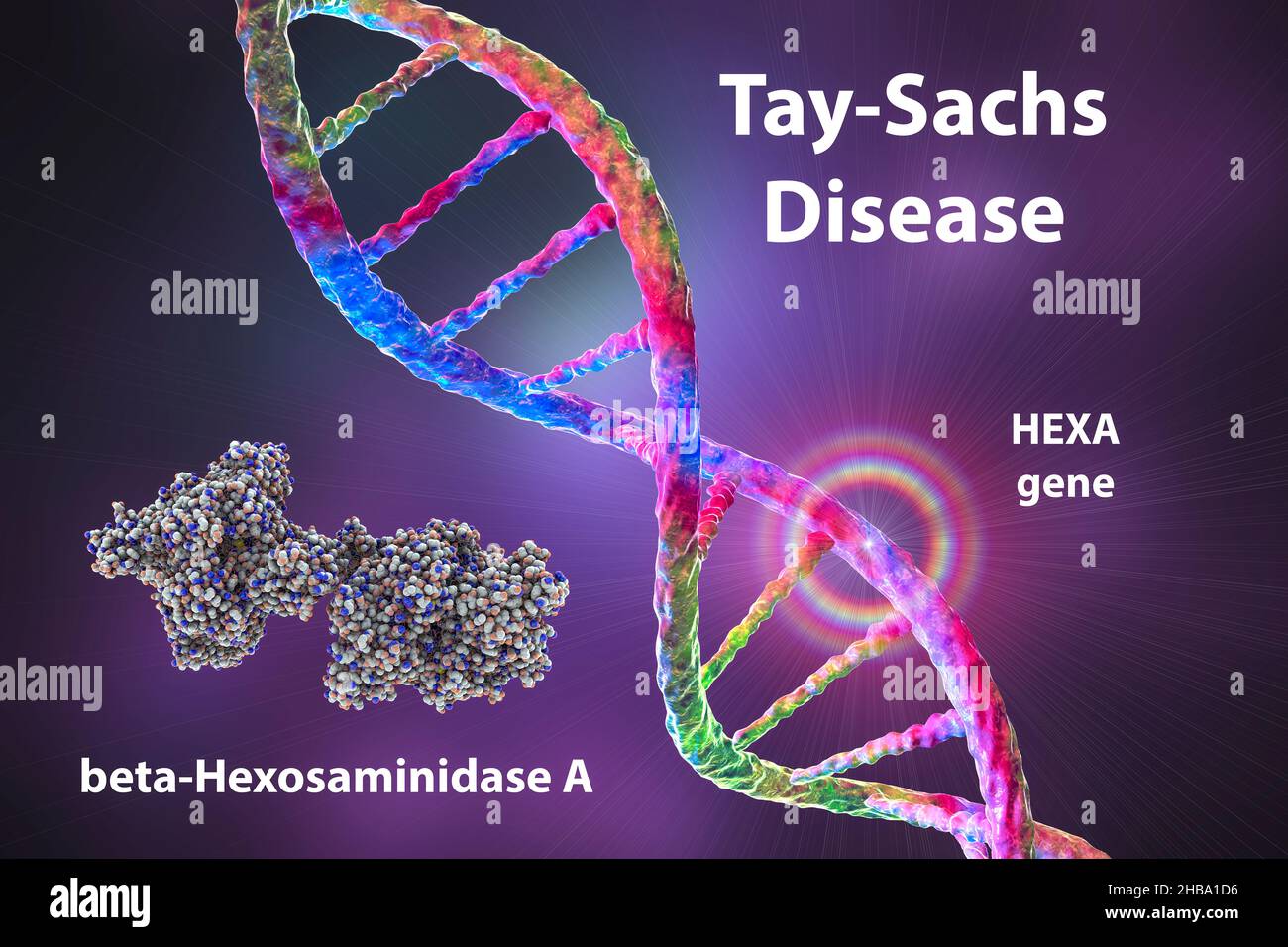 Tay-Sachs disease, illustration. A genetic disorder that progressively destroys brain neurons. It is caused by a mutation in the HEXA gene of chromosome 15 leading to deficiency of hexosaminidase A. Tay-sachs is most commonly seen in infants, manifesting in muscle weakness and decreased motor function, vision and hearing loss, and intellectual disability. Stock Photo