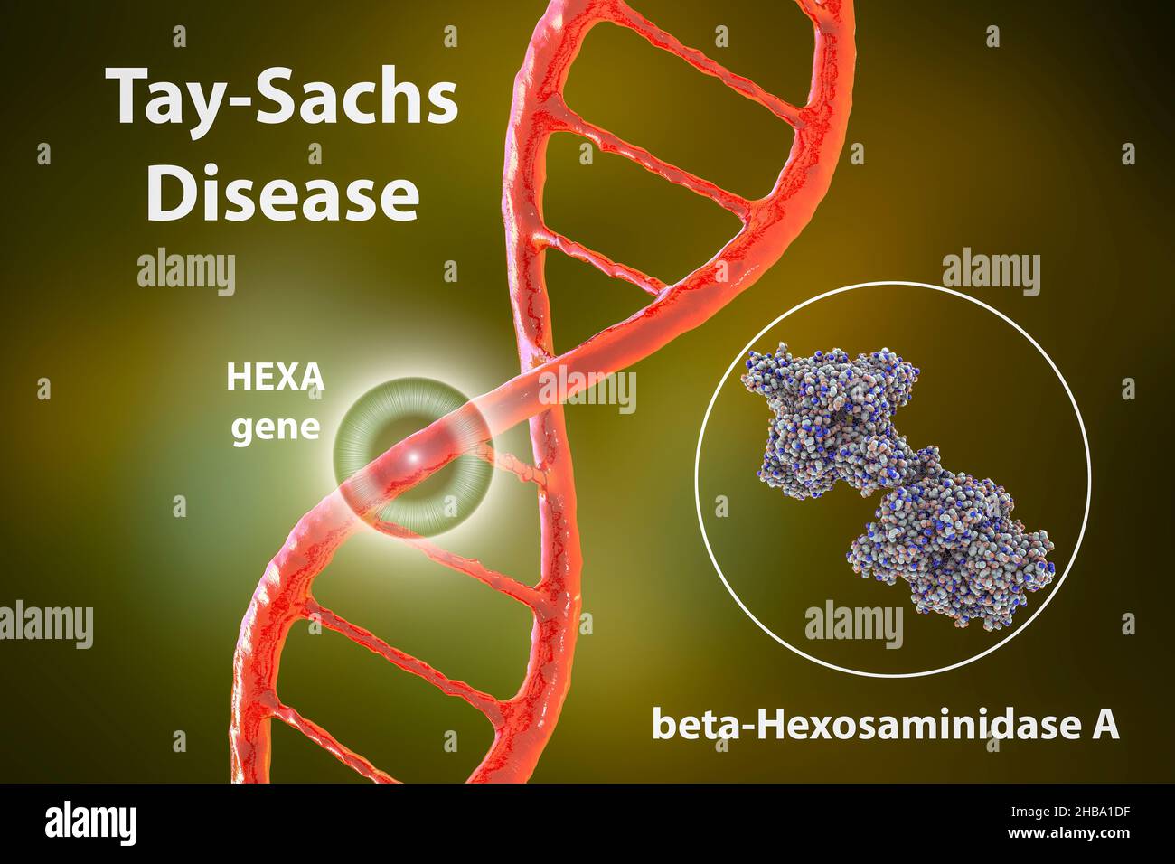 Tay-Sachs disease, illustration. A genetic disorder that progressively destroys brain neurons. It is caused by a mutation in the HEXA gene of chromosome 15 leading to deficiency of hexosaminidase A. Tay-sachs is most commonly seen in infants, manifesting in muscle weakness and decreased motor function, vision and hearing loss, and intellectual disability. Stock Photo