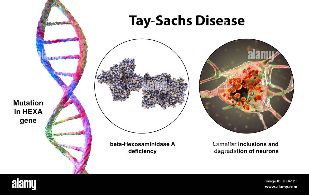 Tay-Sachs disease, illustration. A genetic disorder that progressively destroys brain neurons. It is caused by a mutation in the HEXA gene of chromosome 15 leading to deficiency of hexosaminidase A. Neurons become swollen with lamellar inclusions due to accumulation of gangliosides in lysosomes with subsequent neuronal degeneration. Tay-sachs is most commonly seen in infants, manifesting in muscle weakness and decreased motor function, vision and hearing loss, and intellectual disability. Stock Photo