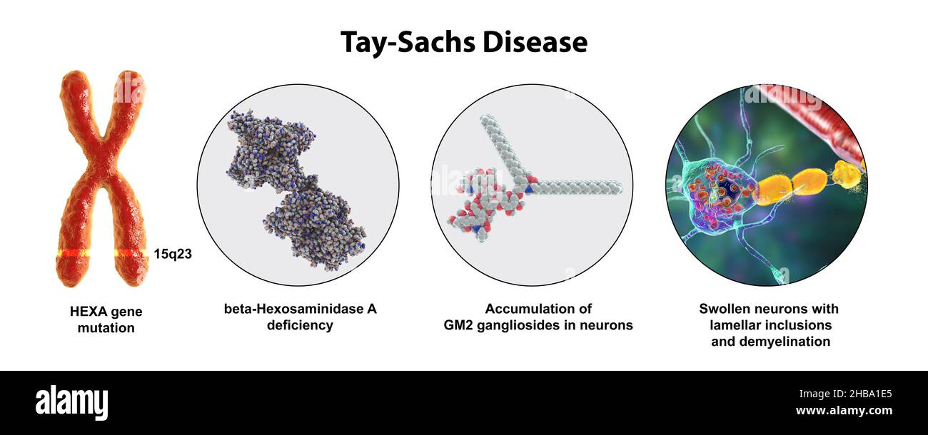 Illustration of Tay-Sachs disease, a genetic disorder that progressively destroys brain neurons. It is caused by a mutation in the HEXA gene of chromosome 15 leading to deficiency of hexosaminidase A. Neurons become swollen with lamellar inclusions due to accumulation of gangliosides in lysosomes with subsequent neuronal degeneration. Tay-sachs is most commonly seen in infants, manifesting in muscle weakness and decreased motor function, vision and hearing loss, and intellectual disability. Stock Photo