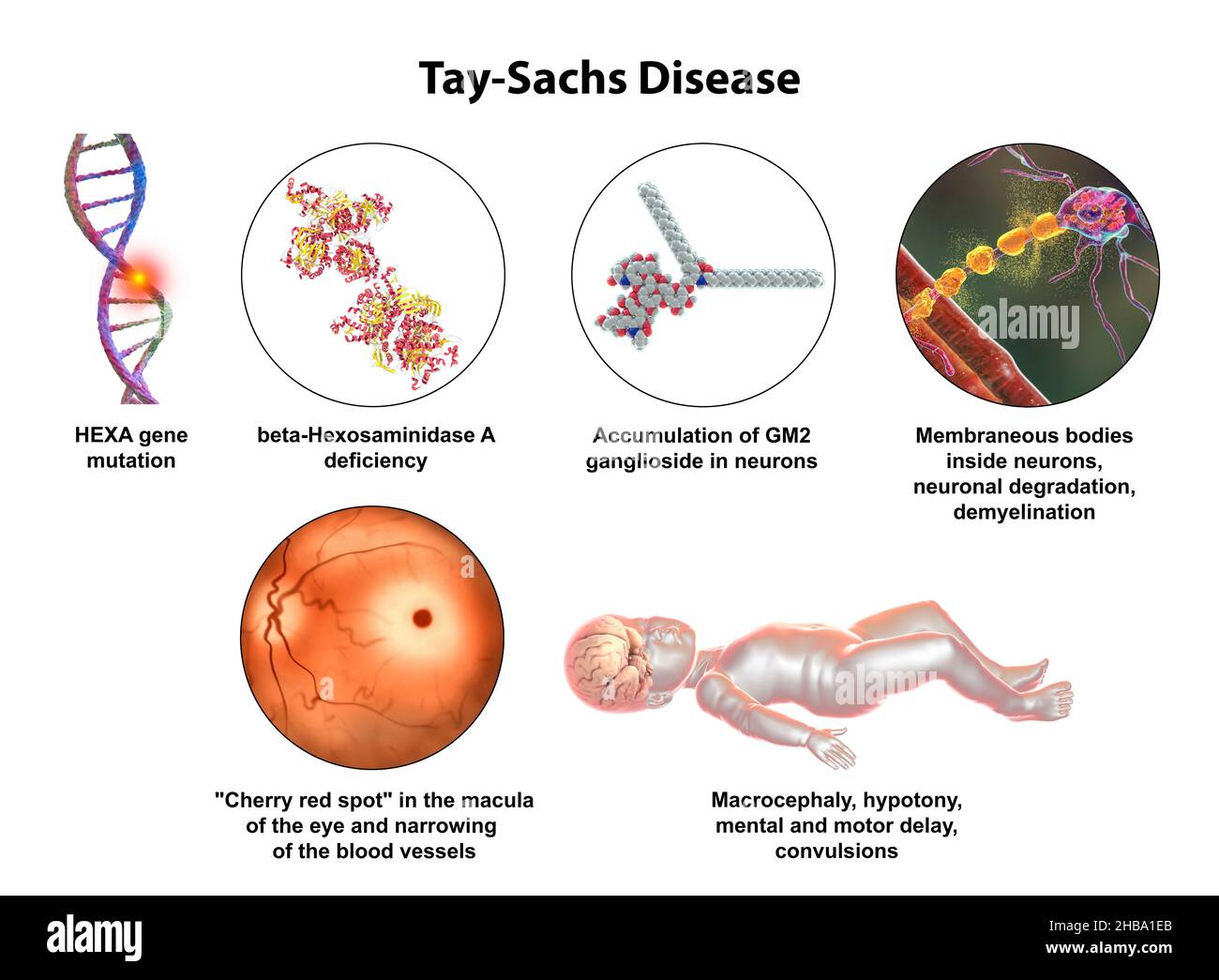 Illustration of Tay-Sachs disease, a genetic disorder that progressively destroys brain neurons. It is caused by a mutation in the HEXA gene of chromo Stock Photo