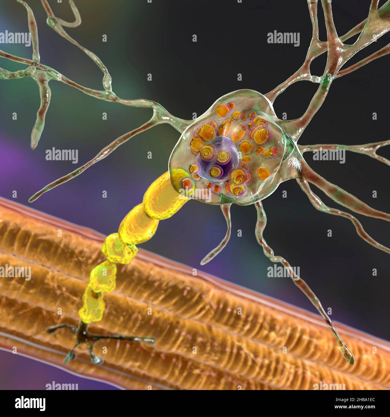 Neurons in Tay-Sachs disease. Illustration showing swollen neurons with membraneous lamellar inclusions due to accumulation of gangliosides in lysosomes, myelin degradation. Tay-Sachs disease is a  disorder that progressively destroys brain neurons, is caused by a mutation in the HEXA gene of chromosome 15 leading to deficiency of hexosaminidase A. Tay-sachs is most commonly seen in infants, manifesting in muscle weakness and decreased motor function, vision and hearing loss, and intellectual disability. Stock Photo