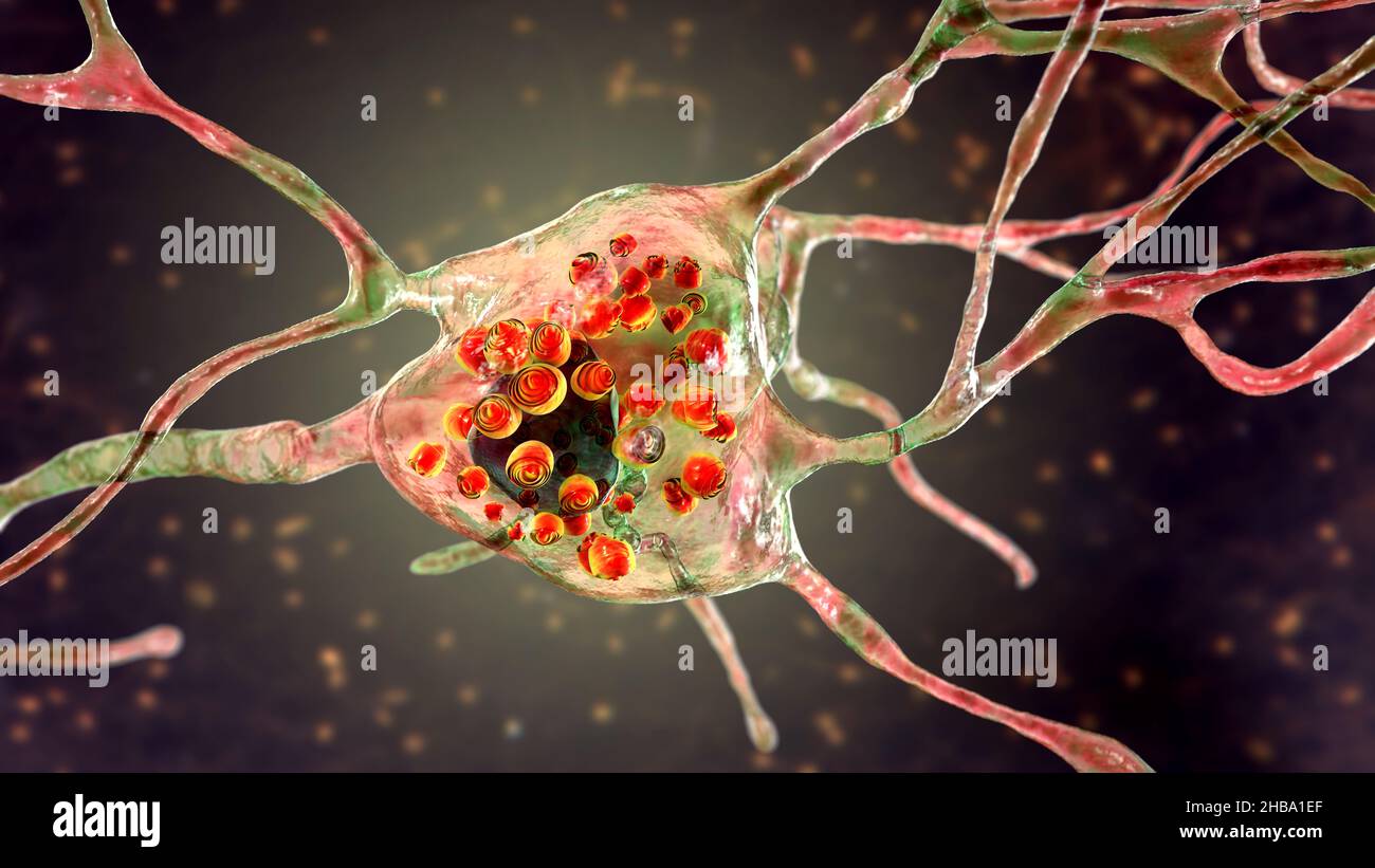 Neurons in Tay-Sachs disease. Illustration showing swollen neurons with membraneous lamellar inclusions due to accumulation of gangliosides in lysosomes. Tay-Sachs disease is a  disorder that progressively destroys brain neurons, is caused by a mutation in the HEXA gene of chromosome 15 leading to deficiency of hexosaminidase A. Tay-sachs is most commonly seen in infants, manifesting in muscle weakness and decreased motor function, vision and hearing loss, and intellectual disability. Stock Photo