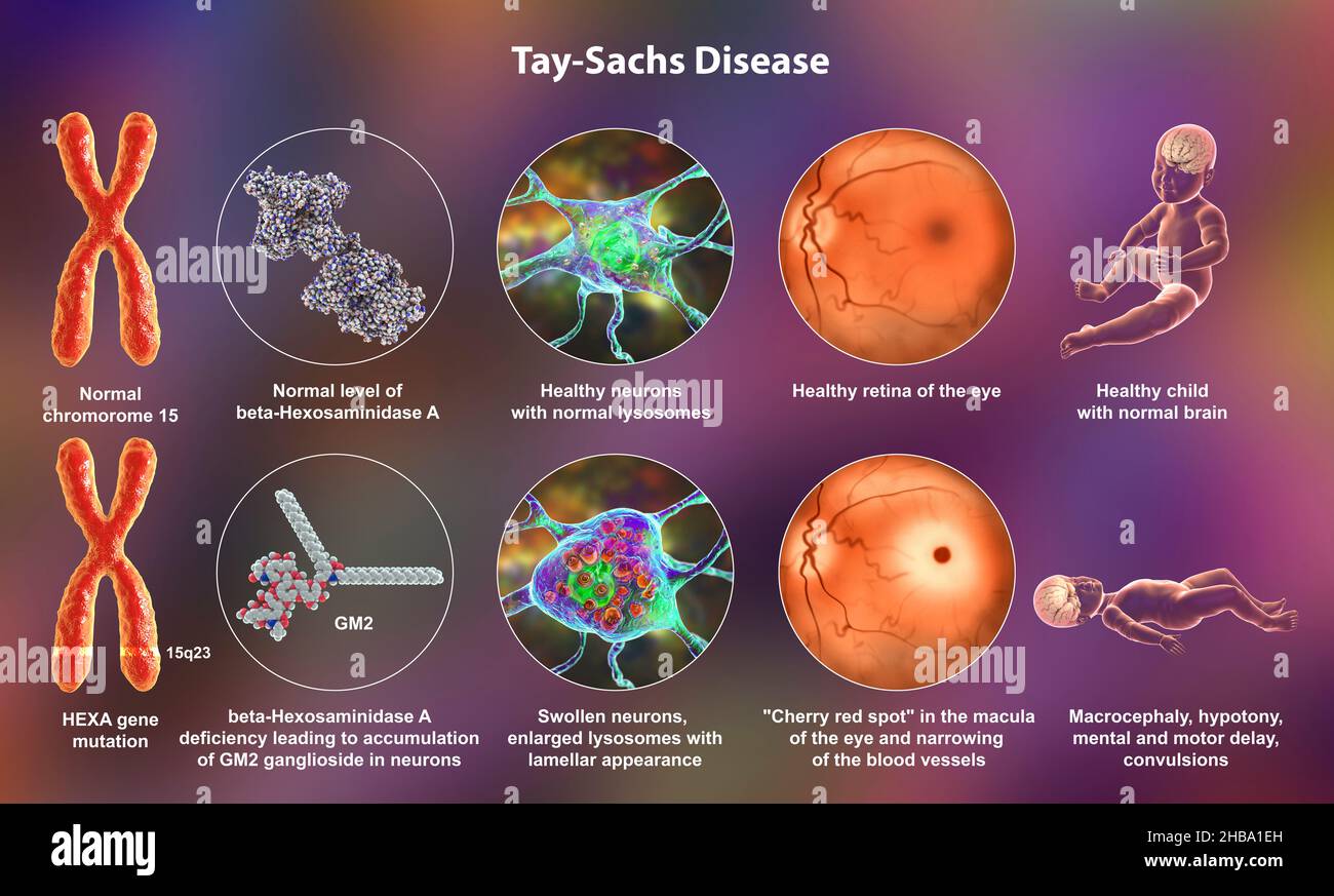 Illustration of Tay-Sachs disease, a genetic disorder that progressively destroys brain neurons. It is caused by a mutation in the HEXA gene of chromo Stock Photo