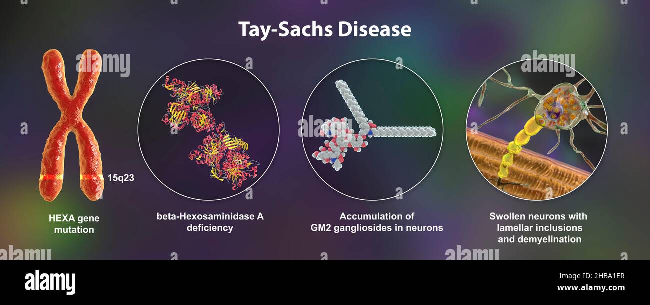 Illustration of Tay-Sachs disease, a genetic disorder that progressively destroys brain neurons. It is caused by a mutation in the HEXA gene of chromosome 15 leading to deficiency of hexosaminidase A. Neurons become swollen with lamellar inclusions due to accumulation of gangliosides in lysosomes with subsequent neuronal degeneration. Tay-sachs is most commonly seen in infants, manifesting in muscle weakness and decreased motor function, vision and hearing loss, and intellectual disability. Stock Photo