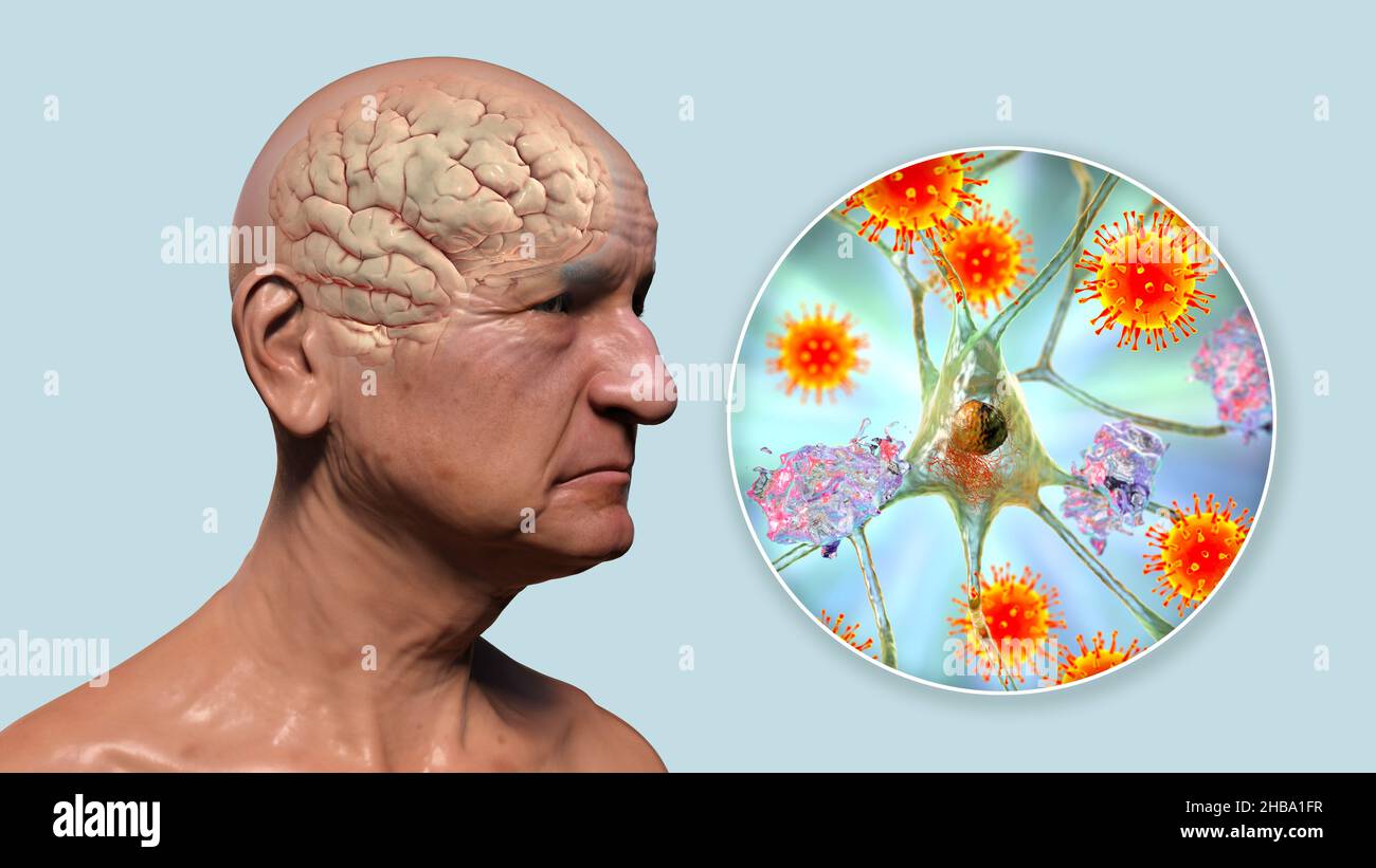 Infectious aetiology of dementia. Conceptual computer illustration showing an elderly person with Alzheimer's disease, progressive impairments of brain functions, amyloid plaques in the brain, and viruses attacking neurons. Stock Photo