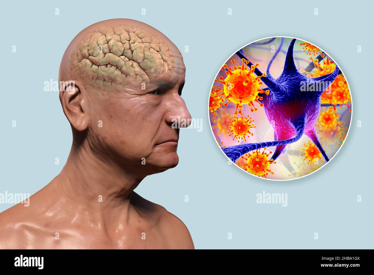 Infectious aetiology of dementia. Conceptual computer illustration showing an elderly person with progressive impairments of brain functions, amyloid plaques in the brain, and viruses attacking neurons. Stock Photo