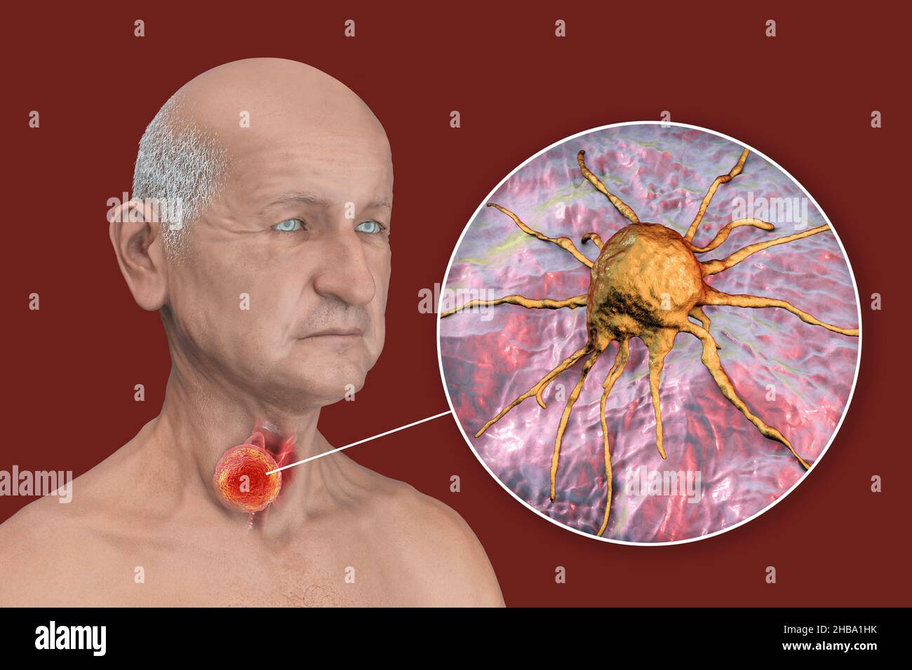 Thyroid gland cancer with a closeup view of cancer cells, computer illustration Stock Photo Alamy