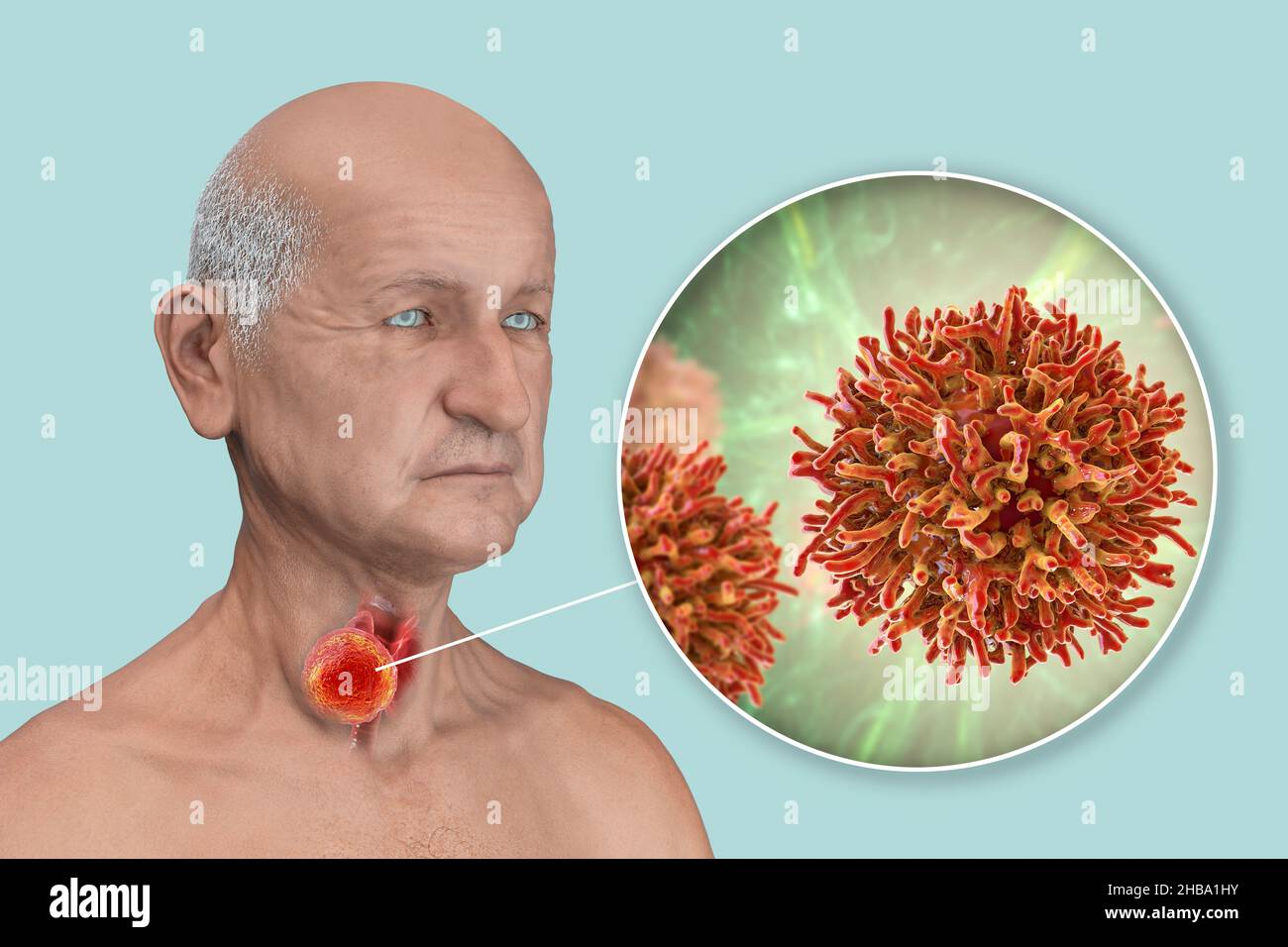Thyroid gland cancer with a closeup view of cancer cells, computer