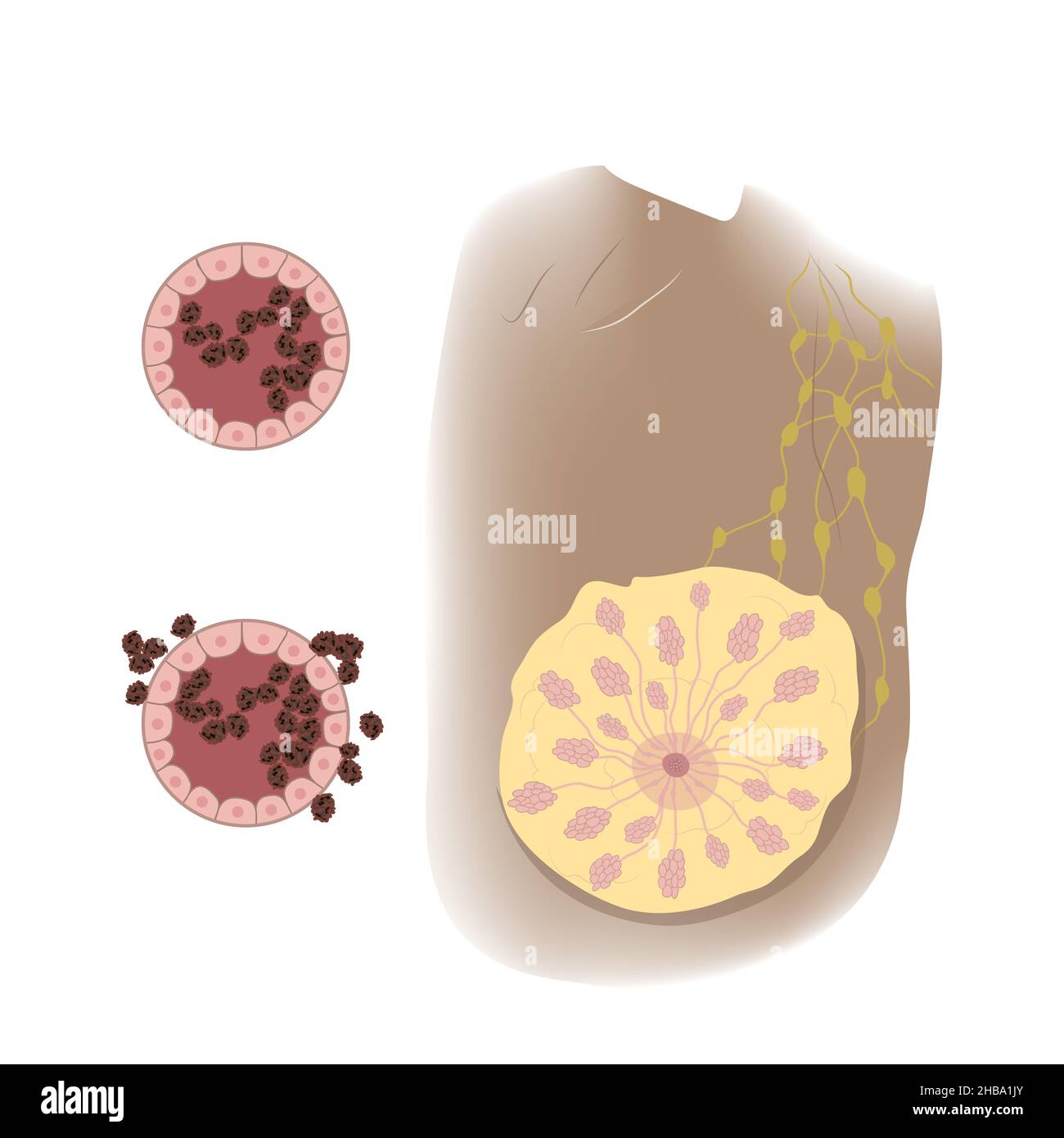 Ductal cancer in female breast, illustration. In situ and invasive stages. Stock Photo
