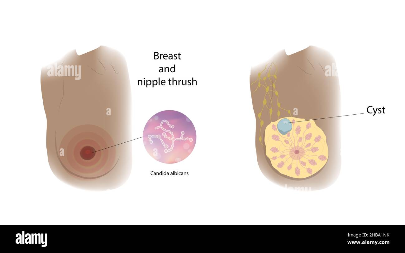 Cyst and breast and nipple thrush comparison, illustration Stock Photo -  Alamy
