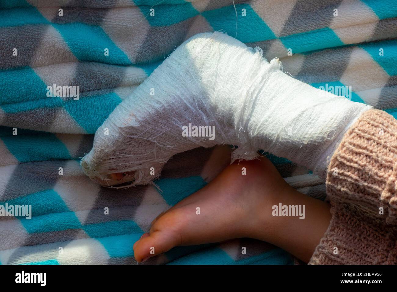 Child with bandage on leg heel fracture. Broken right foot, splint of