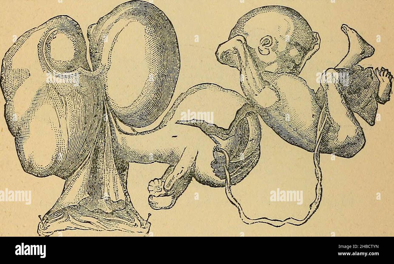 Image showcasing Tubal pregnancy hi-res stock photography and images - Alamy